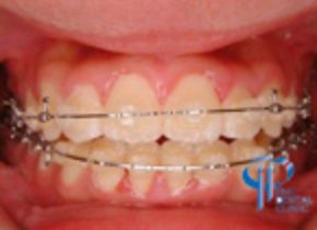 石井歯科クリニック矯正症例