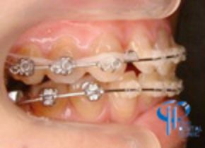 石井歯科クリニック矯正症例