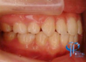 石井歯科クリニック矯正症例