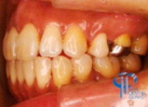 石井歯科クリニック矯正症例