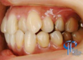 石井歯科クリニック矯正症例