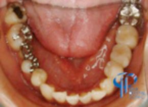 石井歯科クリニック矯正症例